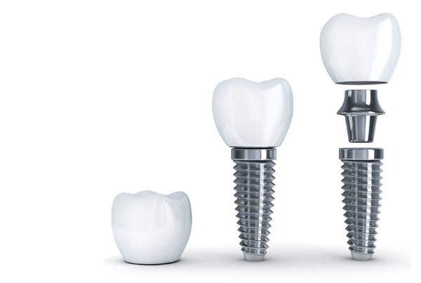 Dental Implants