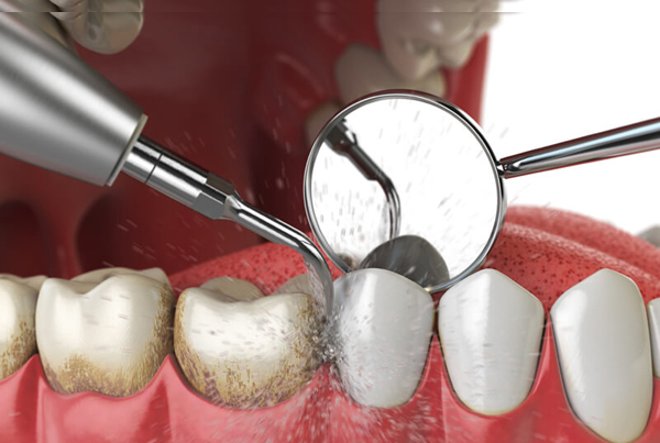 Dental Scaling